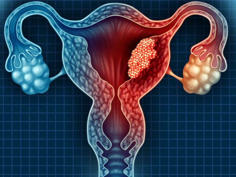 女性患多囊卵巢的4大原因分析