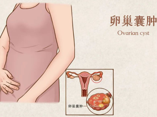 怀疑卵巢囊肿需要做的检查项目
