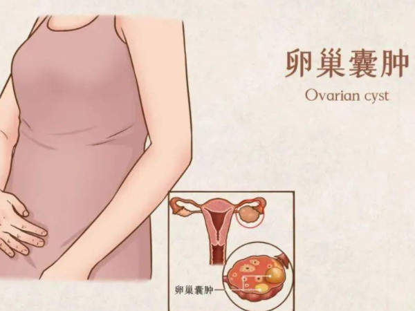卵巢囊肿蒂扭转的主要特点