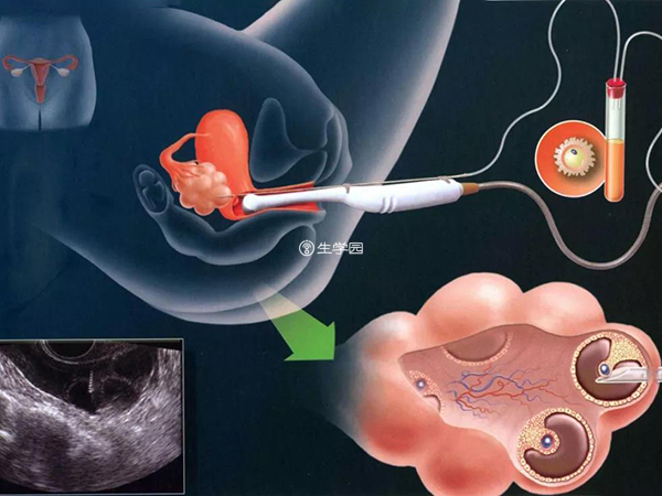 赴美试管女性取卵的全过程