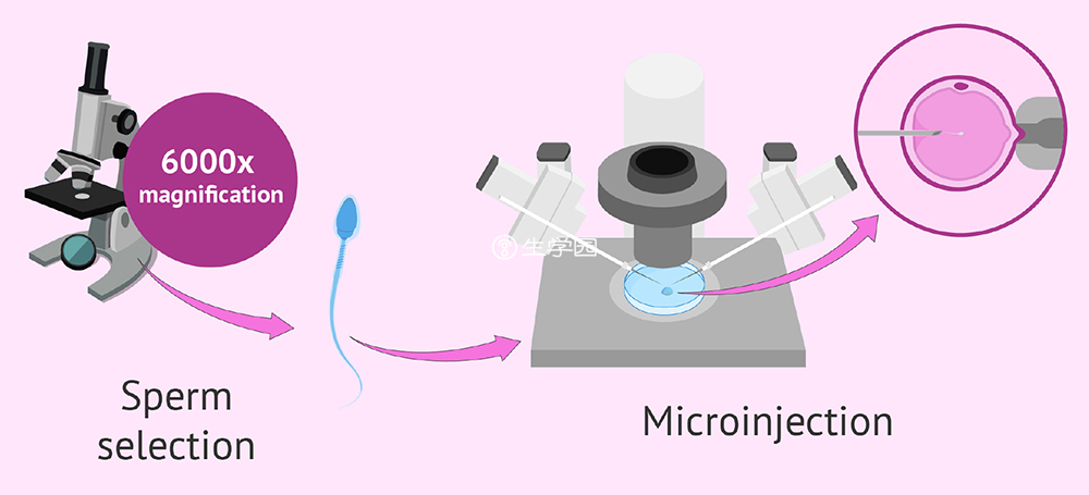 卵胞浆内单精子显微注射技术