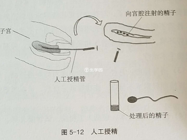 辅助生殖技术分为人工授精和试管婴儿