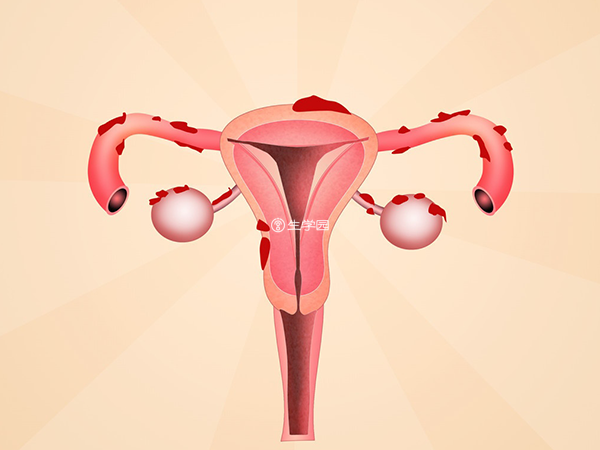 很多育龄女性有多囊卵巢的问题