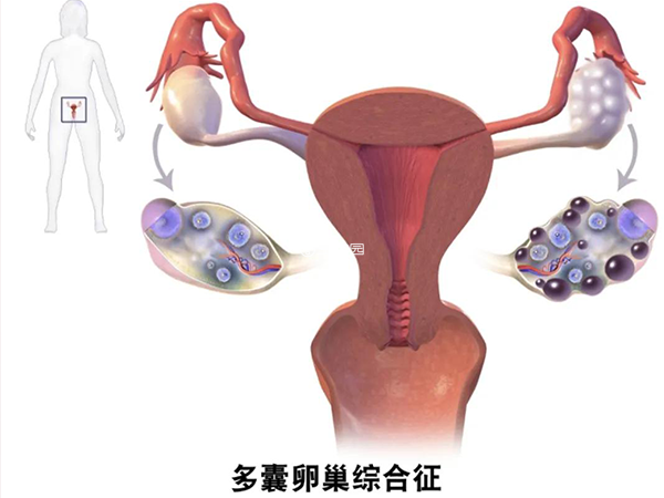 多囊会导致女性不孕