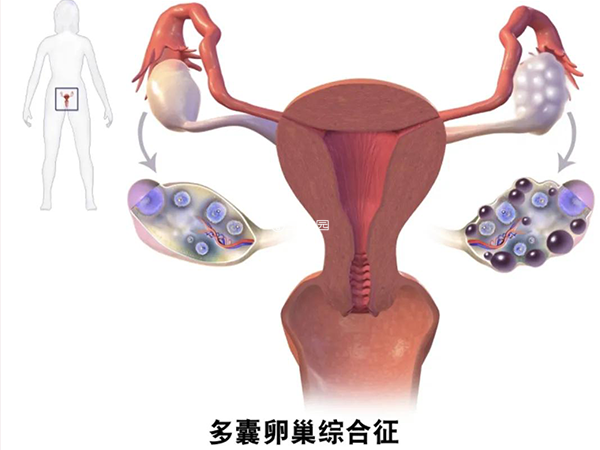 多囊卵巢是引起不孕的主要原因