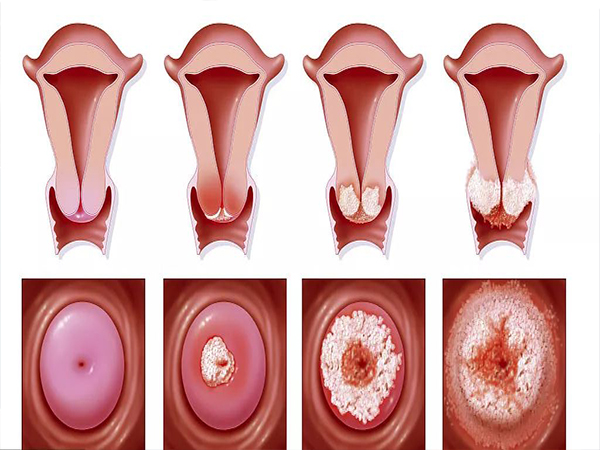 阴道出血可能是宫禁糜烂导致的