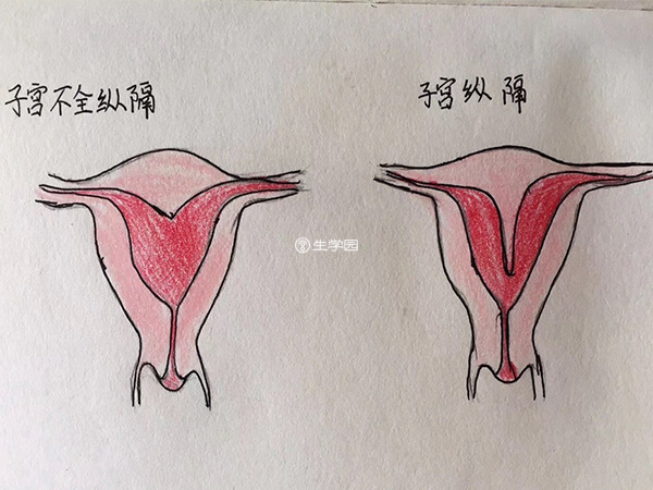 子宫纵隔会影响胚胎着床率