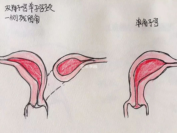 單角子宮赴柬試管有危害