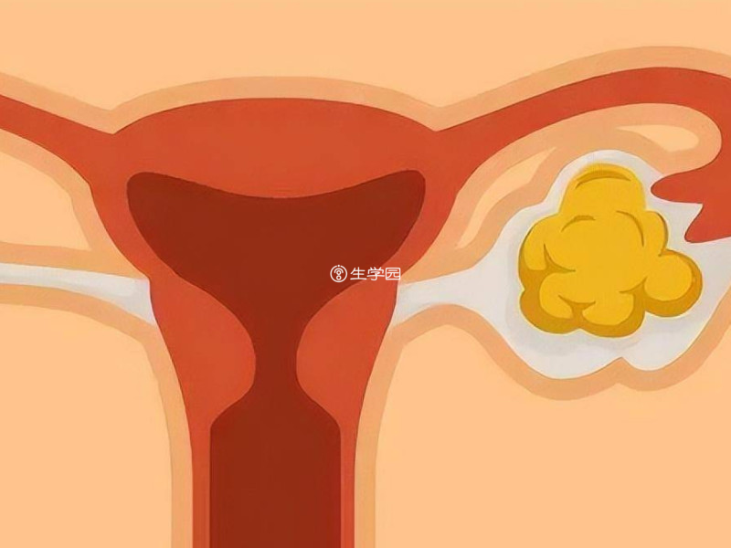 卵巢巧克力囊肿需要做手术