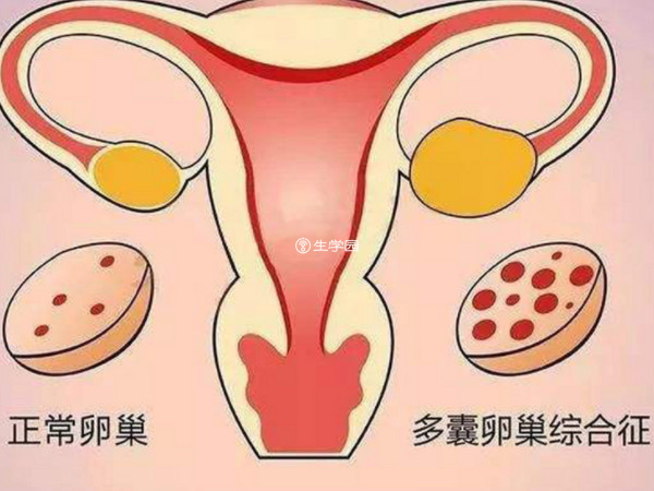 多囊卵巢综合症可以到泰国做试管